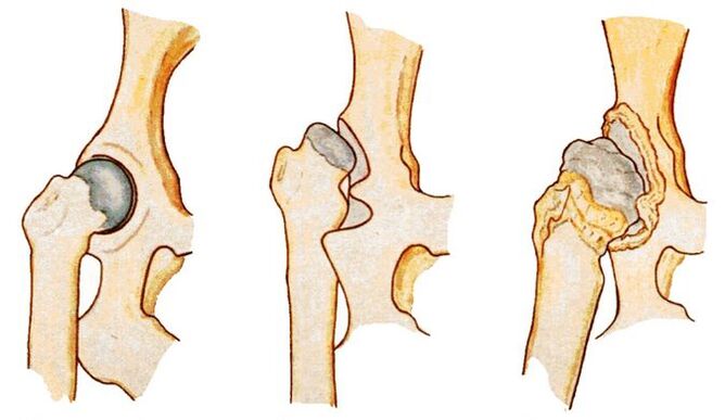 La displasia dell'anca è una causa di coxartrosi secondaria