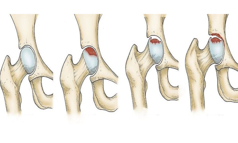 Progressione del dolore all'anca