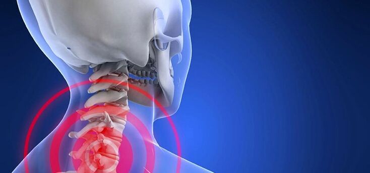 Osteocondrosi della regione di cervice