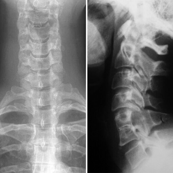 X -raggi la colonna cervicale