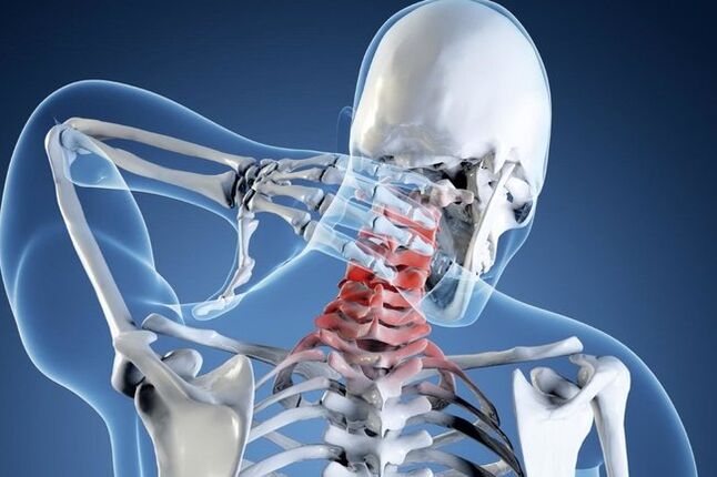 Osteocondrosi della regione di cervice
