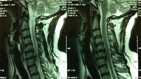 MRI del dipartimento di cervice