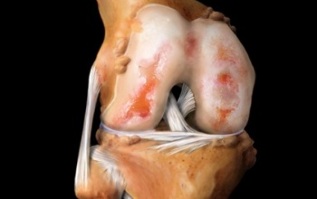 Cos'è l'artrosi del ginocchio