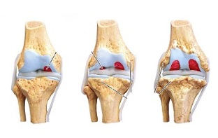 Fasi dell'osteoartrosi dell'articolazione del ginocchio