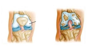 cambiamenti patologici nell'osteoartrosi del ginocchio