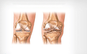 Artrosi del ginocchio