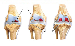 Fasi dell'osteoartrosi del ginocchio