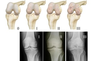 Metodi di diagnosi dell'osteoartrosi del ginocchio