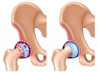 La sconfitta dell'articolazione dell'anca con l'osteoartrosi