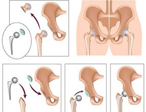 Endoprotesi per l'osteoartrosi dell'articolazione dell'anca