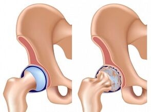 Sintomi dell'osteoartrosi dell'articolazione dell'anca