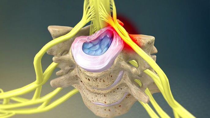 Il rigonfiamento del disco intervertebrale è la causa del dolore al collo