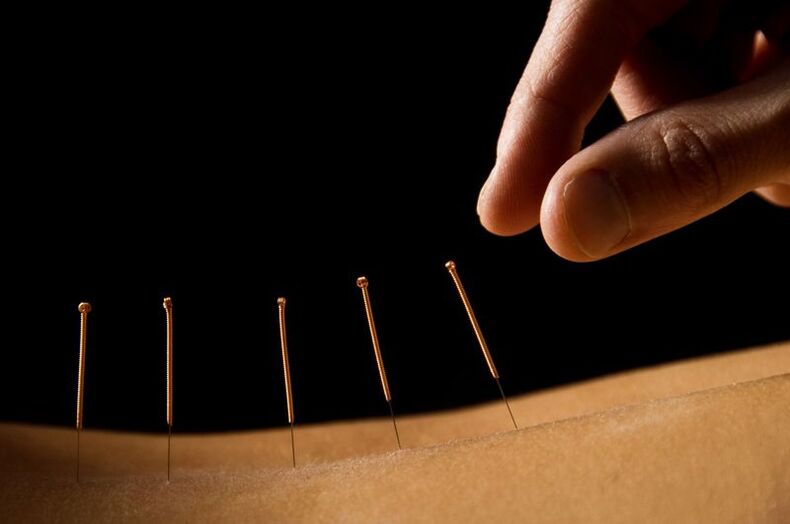 Agopuntura per il mal di schiena